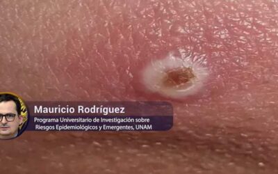 Brote de MPOX no es por ahora, un problema en México – UNAM